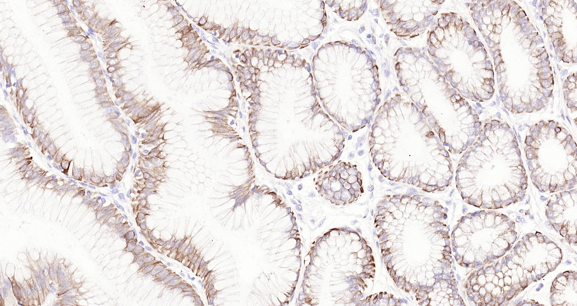 Paraformaldehyde-fixed, paraffin embedded (human gastric carcinoma); Antigen retrieval by boiling in sodium citrate buffer (pH6.0) for 15min; Block endogenous peroxidase by 3% hydrogen peroxide for 20 minutes; Blocking buffer (normal goat serum) at 37°C for 30min; Antibody incubation with (Cytokeratin 8) Monoclonal Antibody, Unconjugated (bsm-33061M) at 1:200 overnight at 4°C, followed by operating according to SP Kit(Mouse)(sp-0024 bs-0296G-Bio 1:2000) instructionsand DAB staining.
