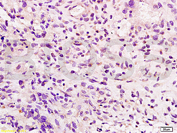 Formalin-fixed and paraffin embedded human glioma tissue labeled with Anti-Integrin beta 7 Polyclonal Antibody, Unconjugated (bs-1051R) at 1:200, followed by conjugation to the secondary antibody and DAB staining