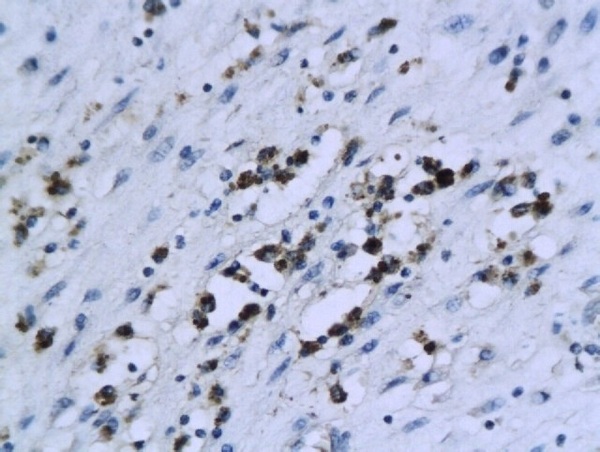 Formalin-fixed and paraffin embedded human endometrial tissue labeled with Anti-XIAP\/BIRC4 Polyclonal Antibody, Unconjugated (bs-1281R) followed by conjugation to the secondary antibody and DAB staining