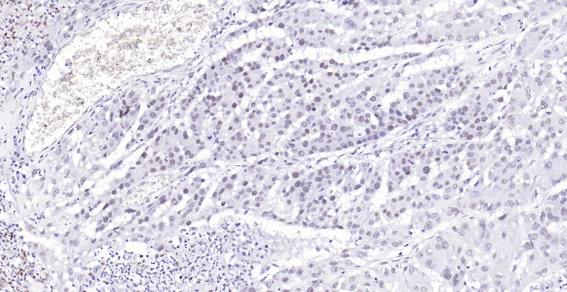Paraformaldehyde-fixed, paraffin embedded (human lung carcinoma); Antigen retrieval by boiling in sodium citrate buffer (pH6.0) for 15min; Block endogenous peroxidase by 3% hydrogen peroxide for 20 minutes; Blocking buffer (normal goat serum) at 37°C for 30min; Antibody incubation with (Phospho-YAP1 (Tyr407)) Polyclonal Antibody, Unconjugated (bs-3476R) at 1:200 overnight at 4°C, followed by operating according to SP Kit(Rabbit) (sp-0023) instructionsand DAB staining.
