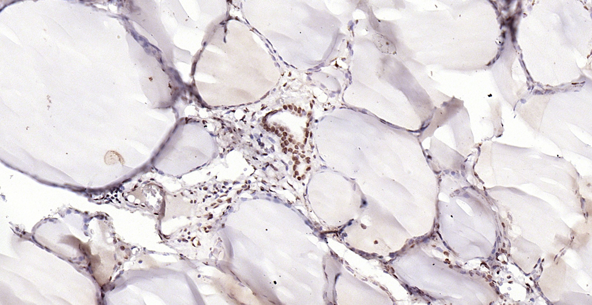 Paraformaldehyde-fixed, paraffin embedded (human thyroid gland); Antigen retrieval by boiling in sodium citrate buffer (pH6.0) for 15min; Block endogenous peroxidase by 3% hydrogen peroxide for 20 minutes; Blocking buffer (normal goat serum) at 37°C for 30min; Antibody incubation with (Phospho-YAP1 (Tyr407)) Polyclonal Antibody, Unconjugated (bs-3476R) at 1:200 overnight at 4°C, followed by operating according to SP Kit(Rabbit) (sp-0023) instructionsand DAB staining.