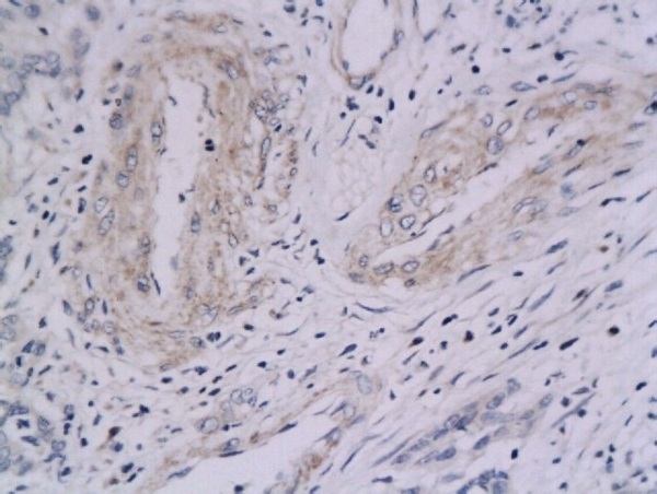 Formalin-fixed and paraffin embedded cervical cancer labeled with Anti-Integrin \u03b1V+\u03b25 Polyclonal Antibody, Unconjugated (bs-1356R)  followed by conjugation to the secondary antibody and DAB staining