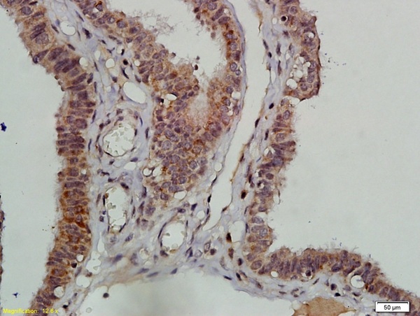 Formalin-fixed and paraffin embedded human ovarian tissue labeled with Anti-DNAPK/PRKDC Polyclonal Antibody, Unconjugated (bs-1359R) followed by conjugation to the secondary antibody and DAB staining