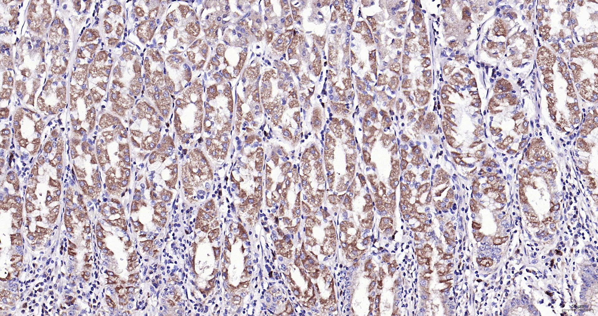 Paraformaldehyde-fixed, paraffin embedded (human gastric); Antigen retrieval by boiling in sodium citrate buffer (pH6.0) for 15min; Block endogenous peroxidase by 3% hydrogen peroxide for 20 minutes; Blocking buffer (normal goat serum) at 37°C for 30min; Antibody incubation with (phospho-BAD (Ser128)) Polyclonal Antibody, Unconjugated (bs-0893R) at 1:200 overnight at 4°C, followed by operating according to SP Kit(Rabbit) (sp-0023) instructionsand DAB staining.