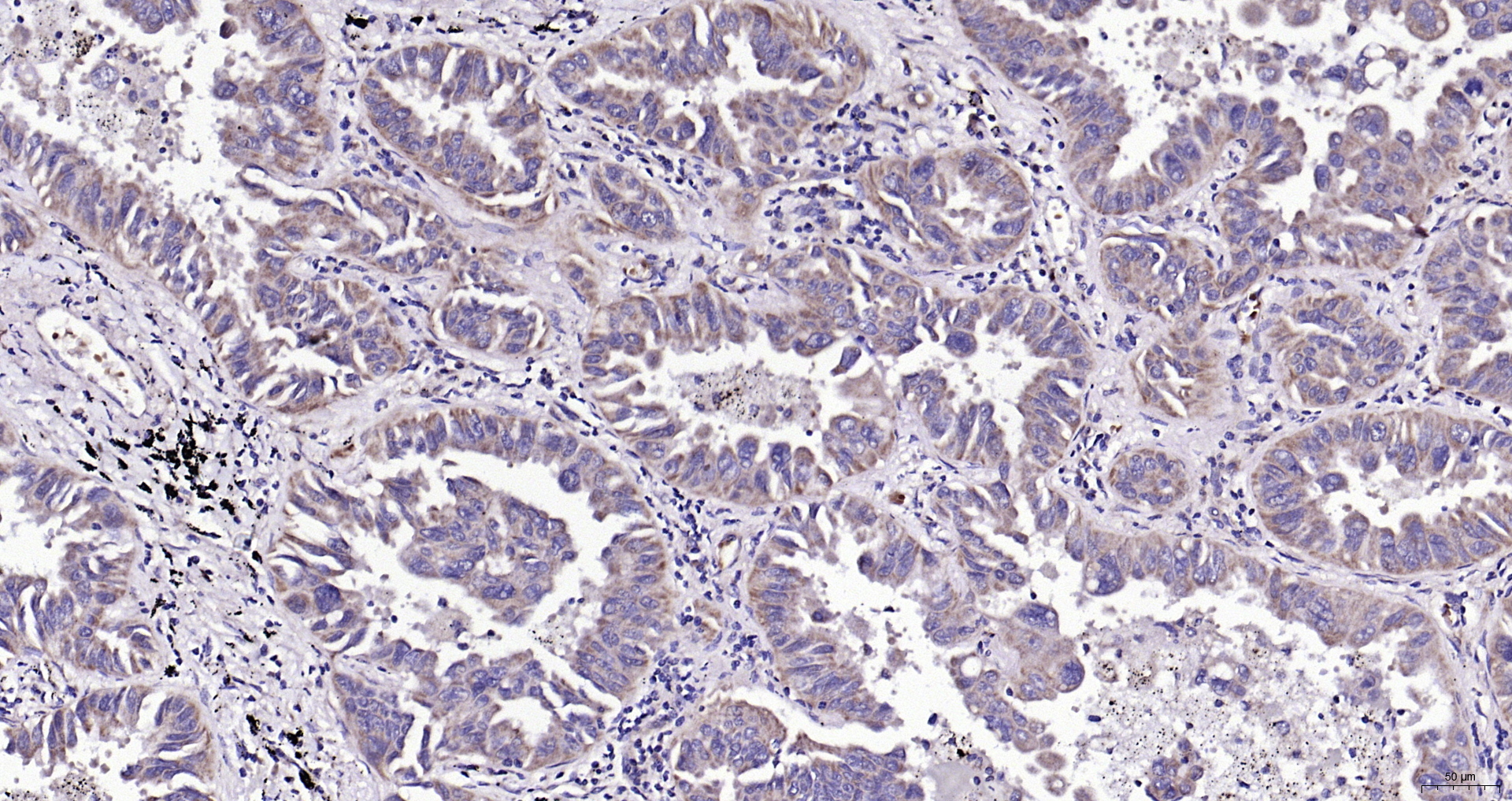 Paraformaldehyde-fixed, paraffin embedded (human lung carcinoma); Antigen retrieval by boiling in sodium citrate buffer (pH6.0) for 15min; Block endogenous peroxidase by 3% hydrogen peroxide for 20 minutes; Blocking buffer (normal goat serum) at 37°C for 30min; Antibody incubation with (Bad ) Polyclonal Antibody, Unconjugated (bs-1304R) at 1:200 overnight at 4°C, followed by operating according to SP Kit(Rabbit) (sp-0023) instructionsand DAB staining.