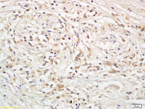 Formalin-fixed and paraffin embedded human rectal cancer labeled with Anti-Snail/SNAI 1 Polyclonal Antibody, Unconjugated (bs-1371R) followed by conjugation to the secondary antibody and DAB staining