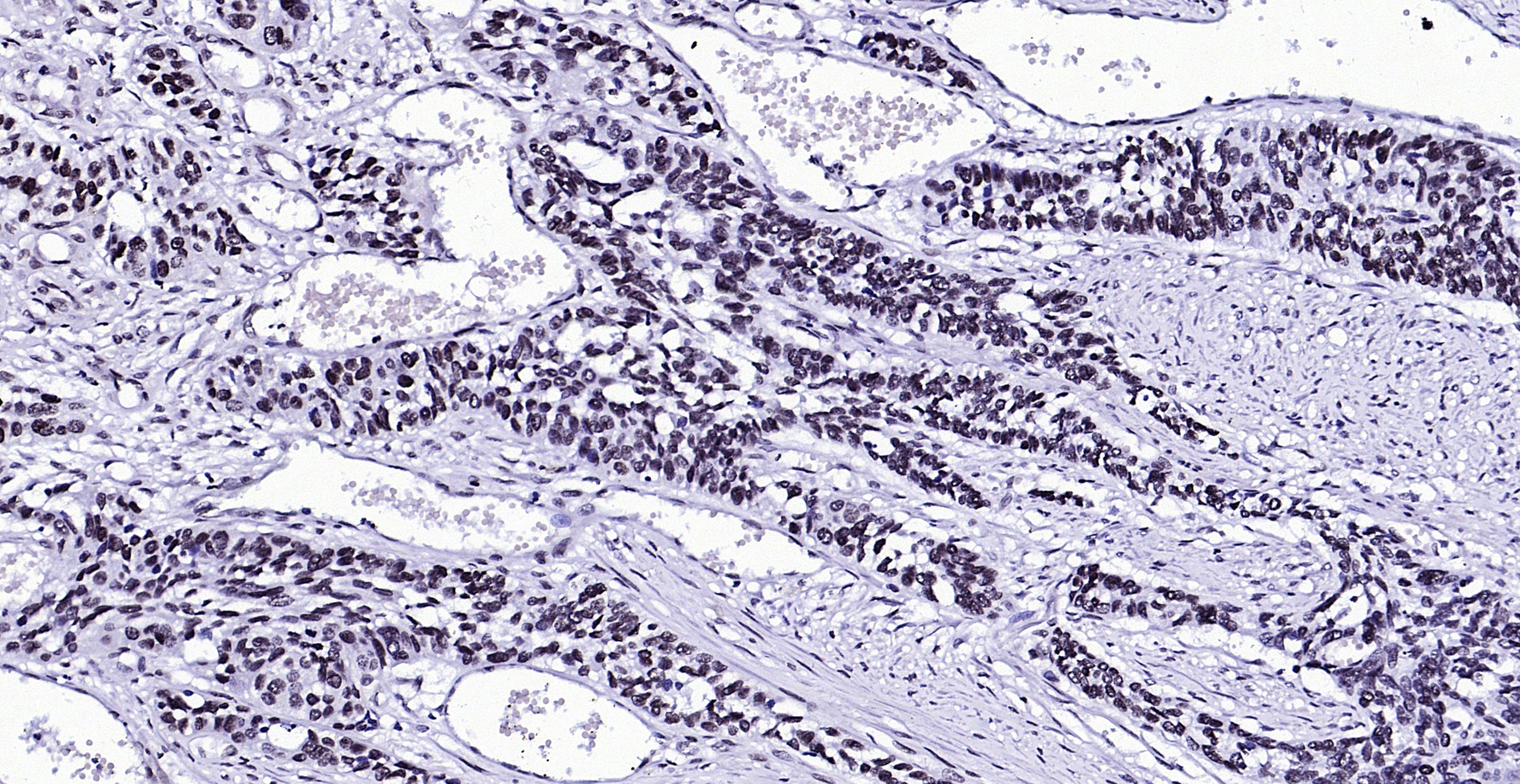 Paraformaldehyde-fixed, paraffin embedded (Human esophageal cancer); Antigen retrieval by boiling in sodium citrate buffer (pH6.0) for 15min; Block endogenous peroxidase by 3% hydrogen peroxide for 20 minutes; Blocking buffer (normal goat serum) at 37°C for 30min; Antibody incubation with (Phospho-FGFR1 (Tyr307)) Polyclonal Antibody, Unconjugated (bs-5325R) at 1:200 overnight at 4°C, followed by operating according to SP Kit(Rabbit) (sp-0023) instructionsand DAB staining.