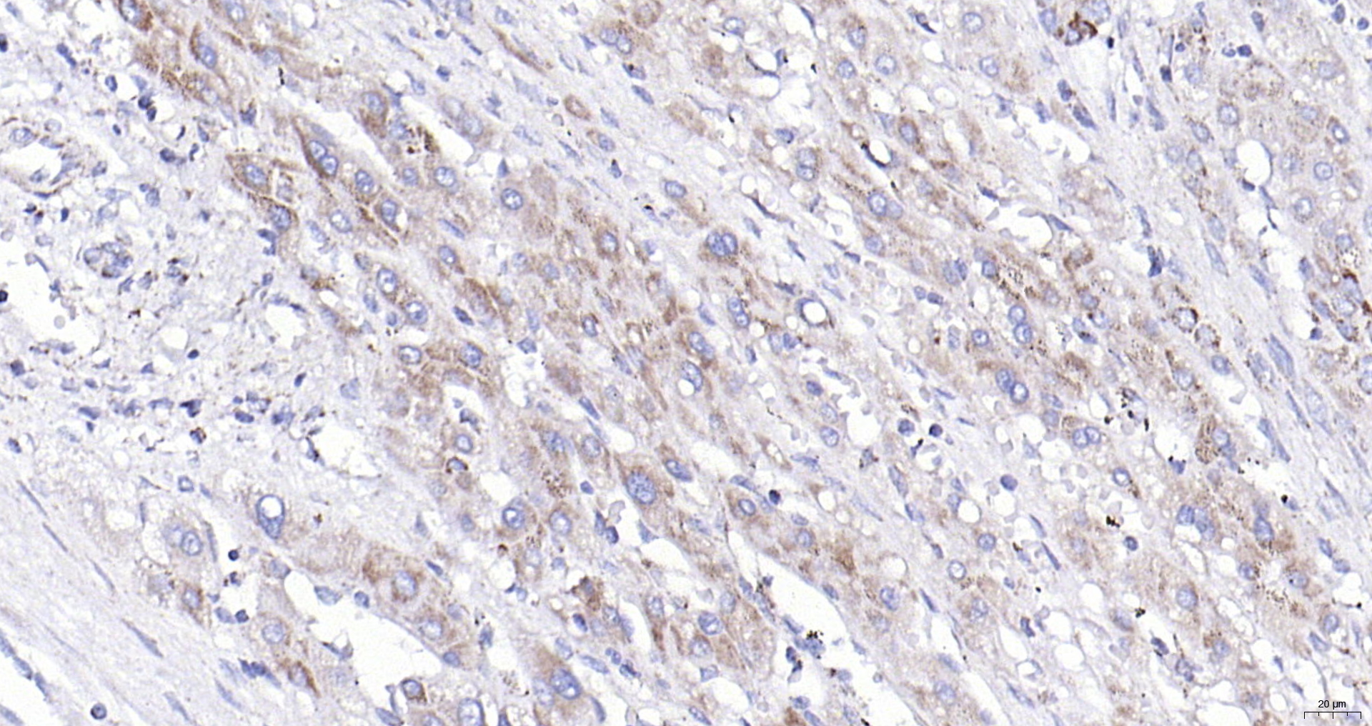 Paraformaldehyde-fixed, paraffin embedded (human liver carcinoma); Antigen retrieval by boiling in sodium citrate buffer (pH6.0) for 15min; Block endogenous peroxidase by 3% hydrogen peroxide for 20 minutes; Blocking buffer (normal goat serum) at 37°C for 30min; Antibody incubation with (COX6c) Polyclonal Antibody, Unconjugated (bs-12925R) at 1:200 overnight at 4°C, followed by operating according to SP Kit(Rabbit) (sp-0023) instructionsand DAB staining.