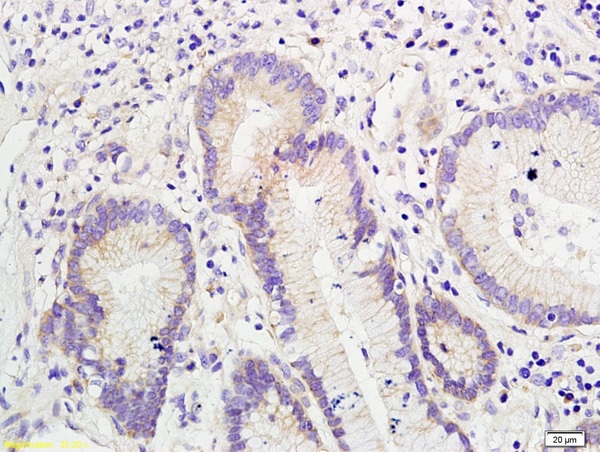 Formalin-fixed and paraffin embedded human colon cancer labeled with Anti-SNAI2/SLUG Polyclonal Antibody, Unconjugated (bs-1382R) followed by conjugation to the secondary antibody and DAB staining