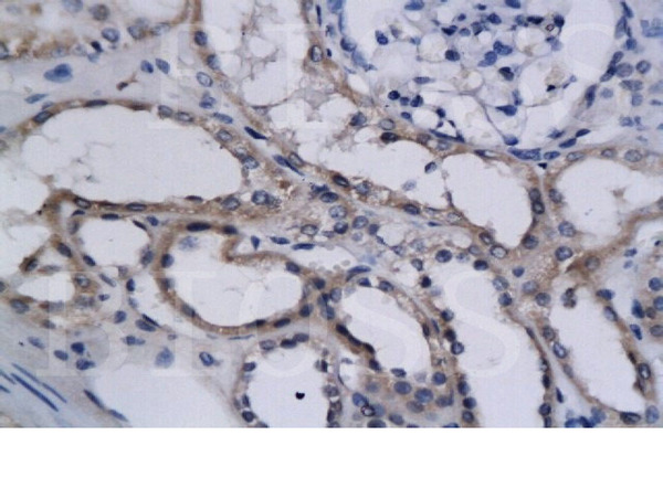 Formalin-fixed and paraffin embedded  human kidney cancer  labeled with Anti-HIF-2\u03b1 Polyclonal Antibody, Unconjugated (bs-1447R)  followed by conjugation to the secondary antibody and DAB staining