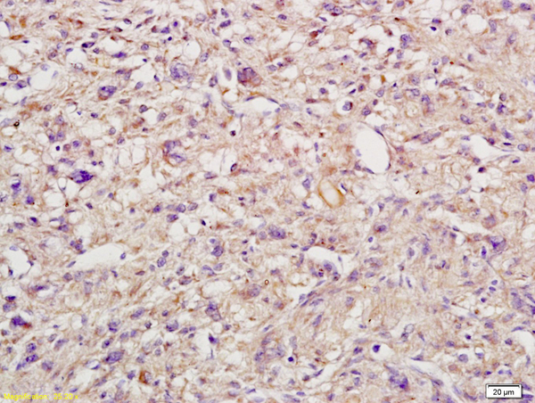 Formalin-fixed and paraffin embedded human endometrial cancer labeled with Anti-IL-6R Beta/CD130/gp130 Polyclonal Antibody, Unconjugated (bs-1459R) followed by conjugation to the secondary antibody and DAB staining