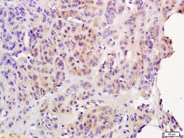 Formalin-fixed and paraffin embedded human endometrial cancer labeled with Anti-IL-6R Beta\/CD130\/gp130 Polyclonal Antibody, Unconjugated (bs-1459R)  followed by conjugation to the secondary antibody and DAB staining