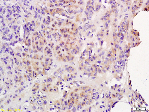 Formalin-fixed and paraffin embedded human endometrial cancer labeled with Anti-IL-6R Beta/CD130/gp130 Polyclonal Antibody, Unconjugated (bs-1459R) followed by conjugation to the secondary antibody and DAB staining