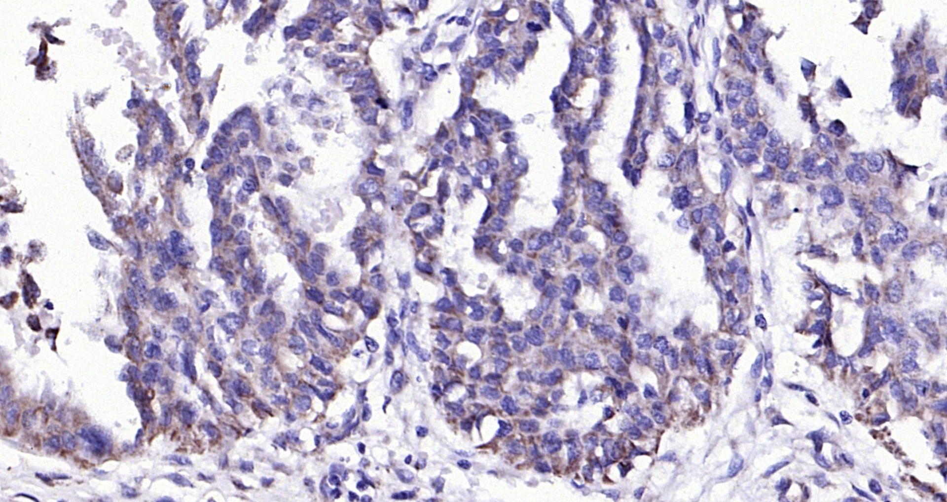 Paraformaldehyde-fixed, paraffin embedded (Human ovarian cancer); Antigen retrieval by boiling in sodium citrate buffer (pH6.0) for 15min; Block endogenous peroxidase by 3% hydrogen peroxide for 20 minutes; Blocking buffer (normal goat serum) at 37°C for 30min; Antibody incubation with (PAI1) Polyclonal Antibody, Unconjugated (bs-6562R) at 1:200 overnight at 4°C, followed by operating according to SP Kit(Rabbit) (sp-0023) instructionsand DAB staining.