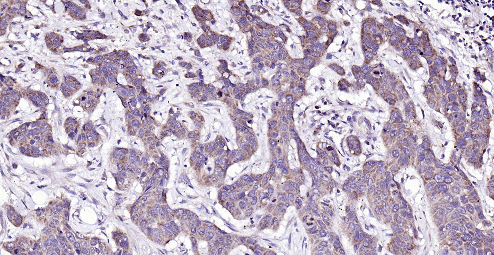 Paraformaldehyde-fixed, paraffin embedded (Human esophageal cancer); Antigen retrieval by boiling in sodium citrate buffer (pH6.0) for 15min; Block endogenous peroxidase by 3% hydrogen peroxide for 20 minutes; Blocking buffer (normal goat serum) at 37°C for 30min; Antibody incubation with (CTHRC1) Polyclonal Antibody, Unconjugated (bs-5882R) at 1:200 overnight at 4°C, followed by operating according to SP Kit(Rabbit) (sp-0023) instructionsand DAB staining.
