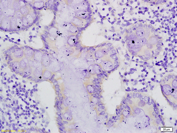 Formalin-fixed and paraffin embedded human colon cancer labeled with Anti-mucin3/Muc3 Polyoclonal Antibody, Unconjugated (bs-1525R) at 1:200 followed by conjugation to the secondary antibody and DAB staining