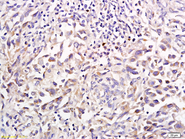 Formalin-fixed and paraffin embedded human gastric cancer labeled with Anti-SHH Polyclonal Antibody, Unconjugated (bs-1544R) followed by conjugation to the secondary antibody and DAB staining