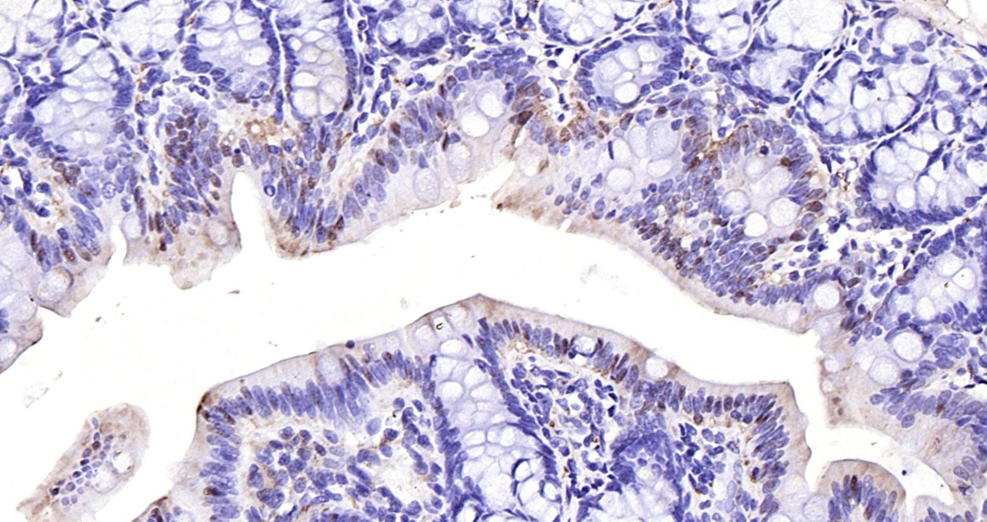 Paraformaldehyde-fixed, paraffin embedded (rat colon); Antigen retrieval by boiling in sodium citrate buffer (pH6.0) for 15min; Block endogenous peroxidase by 3% hydrogen peroxide for 20 minutes; Blocking buffer (normal goat serum) at 37°C for 30min; Antibody incubation with (phospho-p107 (Ser975)) Polyclonal Antibody, Unconjugated (bs-5696R) at 1:200 overnight at 4°C, followed by operating according to SP Kit(Rabbit) (sp-0023) instructionsand DAB staining.