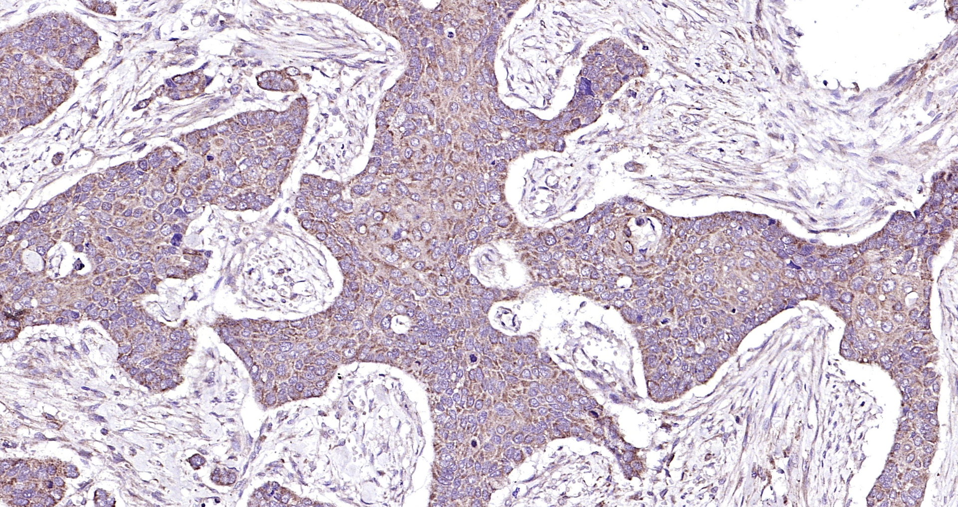 Paraformaldehyde-fixed, paraffin embedded (Human esophageal cancer); Antigen retrieval by boiling in sodium citrate buffer (pH6.0) for 15min; Block endogenous peroxidase by 3% hydrogen peroxide for 20 minutes; Blocking buffer (normal goat serum) at 37°C for 30min; Antibody incubation with (CTHRC1) Polyclonal Antibody, Unconjugated (bs-5882R) at 1:200 overnight at 4°C, followed by operating according to SP Kit(Rabbit) (sp-0023) instructionsand DAB staining.