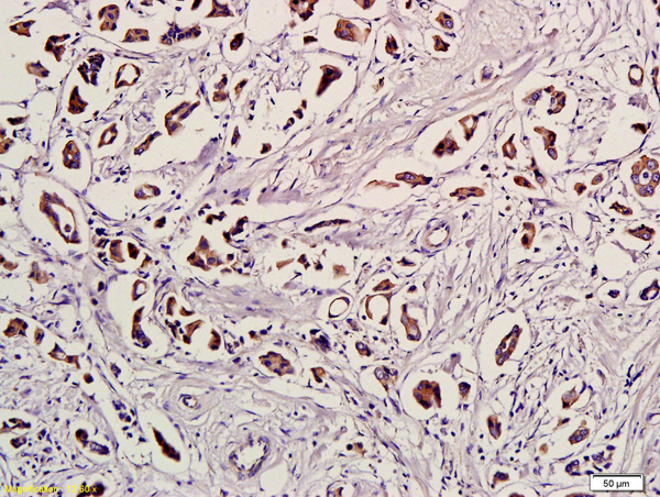 Formalin-fixed and paraffin embedded human breast cancer labeled with Anti-Ubiquitin\/UBC\/UB Polyclonal Antibody, Unconjugated (bs-1549R) followed by conjugation to the secondary antibody and DAB staining