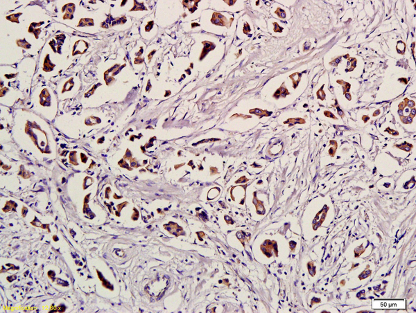 Formalin-fixed and paraffin embedded human breast cancer labeled with Anti-Ubiquitin/UBC/UB Polyclonal Antibody, Unconjugated (bs-1549R) followed by conjugation to the secondary antibody and DAB staining