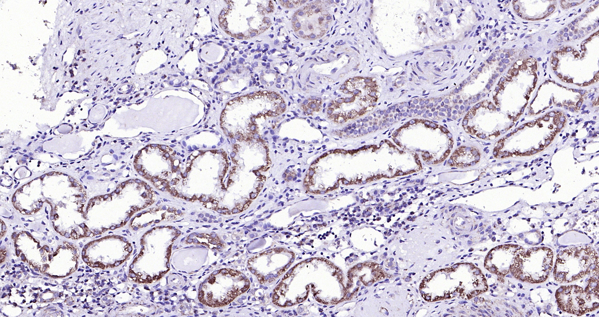 Paraformaldehyde-fixed, paraffin embedded (Human kidney); Antigen retrieval by boiling in sodium citrate buffer (pH6.0) for 15min; Block endogenous peroxidase by 3% hydrogen peroxide for 20 minutes; Blocking buffer (normal goat serum) at 37°C for 30min; Antibody incubation with (Activin Receptor Type IIB) Polyclonal Antibody, Unconjugated (bs-12417R) at 1:200 overnight at 4°C, followed by operating according to SP Kit(Rabbit) (sp-0023) instructionsand DAB staining.