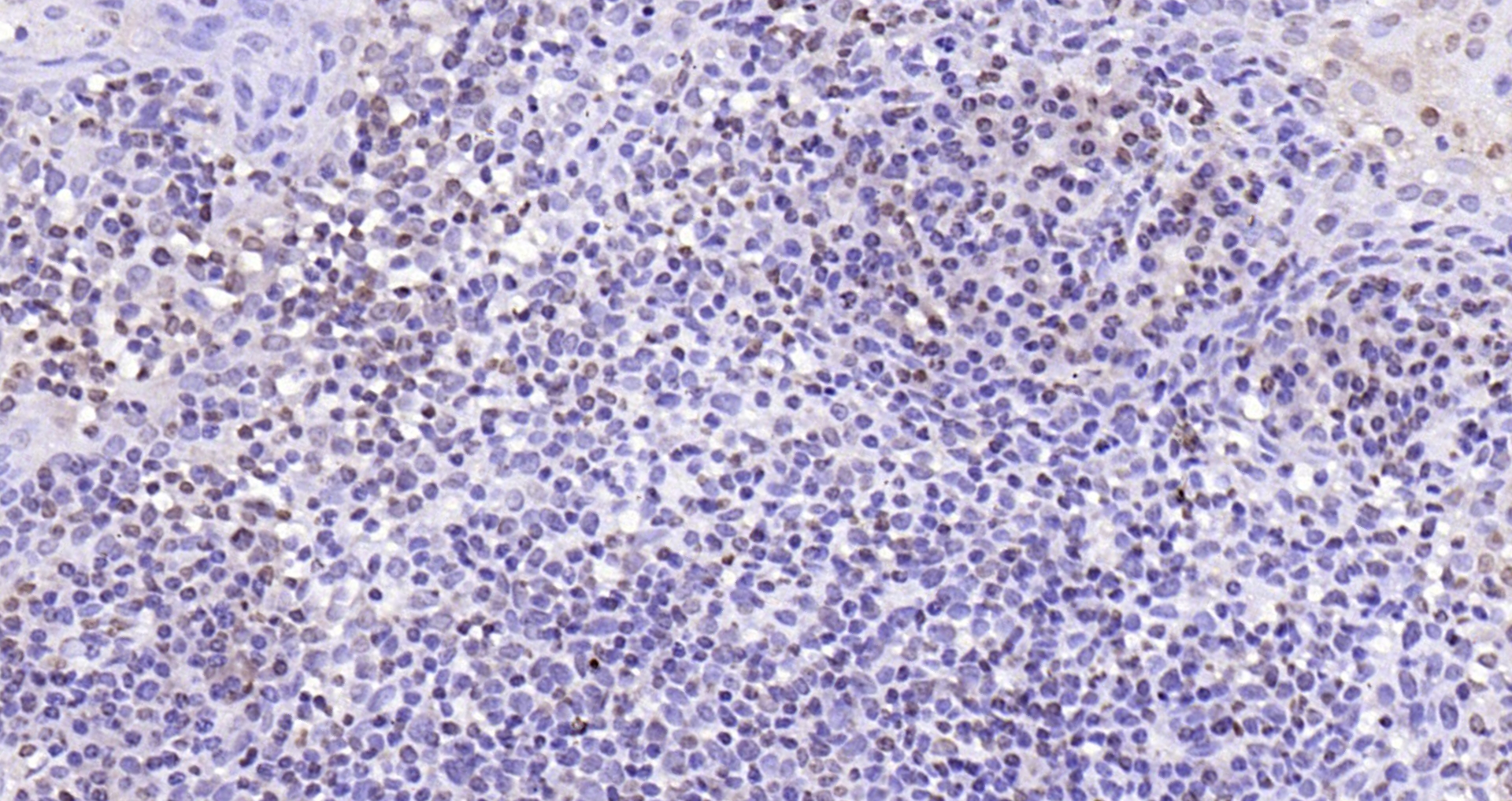 Paraformaldehyde-fixed, paraffin embedded (human tonsil); Antigen retrieval by boiling in sodium citrate buffer (pH6.0) for 15min; Block endogenous peroxidase by 3% hydrogen peroxide for 20 minutes; Blocking buffer (normal goat serum) at 37°C for 30min; Antibody incubation with (IL33) Polyclonal Antibody, Unconjugated (bs-2208R) at 1:200 overnight at 4°C, followed by operating according to SP Kit(Rabbit) (sp-0023) instructionsand DAB staining.