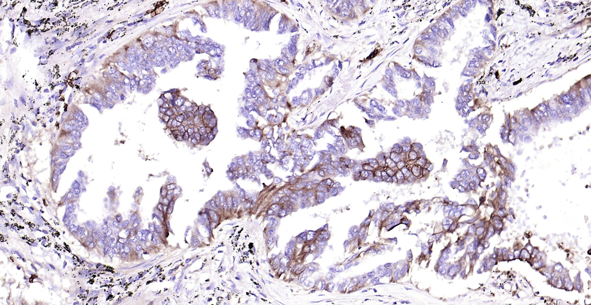 Paraformaldehyde-fixed, paraffin embedded (human lung carcinoma); Antigen retrieval by boiling in sodium citrate buffer (pH6.0) for 15min; Block endogenous peroxidase by 3% hydrogen peroxide for 20 minutes; Blocking buffer (normal goat serum) at 37°C for 30min; Antibody incubation with (GLUT1) Monoclonal Antibody, Unconjugated (bsm-52240R) at 1:200 overnight at 4°C, followed by operating according to SP Kit(Rabbit) (sp-0023) instructionsand DAB staining.