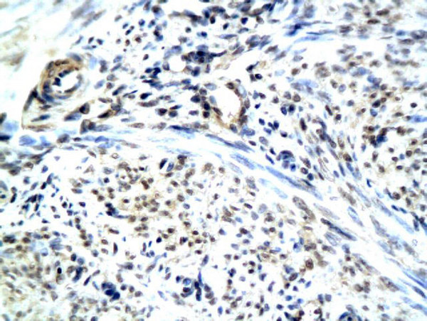 Formalin-fixed and paraffin embedded human uterine endomysium labeled with Anti-RAMP1 Polyclonal Antibody, Unconjugated (bs-1567R) followed by conjugation to the secondary antibody and DAB staining