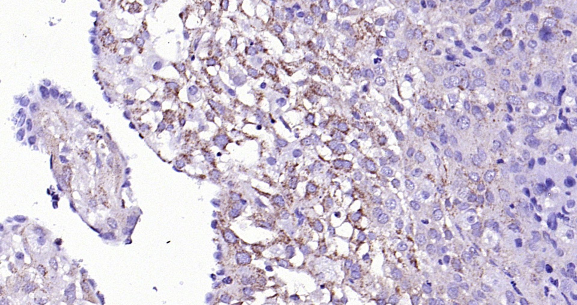Paraformaldehyde-fixed, paraffin embedded (mouse placenta); Antigen retrieval by boiling in sodium citrate buffer (pH6.0) for 15min; Block endogenous peroxidase by 3% hydrogen peroxide for 20 minutes; Blocking buffer (normal goat serum) at 37°C for 30min; Antibody incubation with (Legumain) Polyclonal Antibody, Unconjugated (bs-3907R) at 1:200 overnight at 4°C, followed by operating according to SP Kit(Rabbit) (sp-0023) instructionsand DAB staining. Paraformaldehyde-fixed, paraffin embedded (mouse placenta); Antigen retrieval by boiling in sodium citrate buffer (pH6.0) for 15min; Block endogenous peroxidase by 3% hydrogen peroxide for 20 minutes; Blocking buffer (normal goat serum) at 37°C for 30min; Antibody incubation with (Legumain) Polyclonal Antibody, Unconjugated (bs-3907R) at 1:200 overnight at 4°C, followed by operating according to SP Kit(Rabbit) (sp-0023) instructionsand DAB staining.