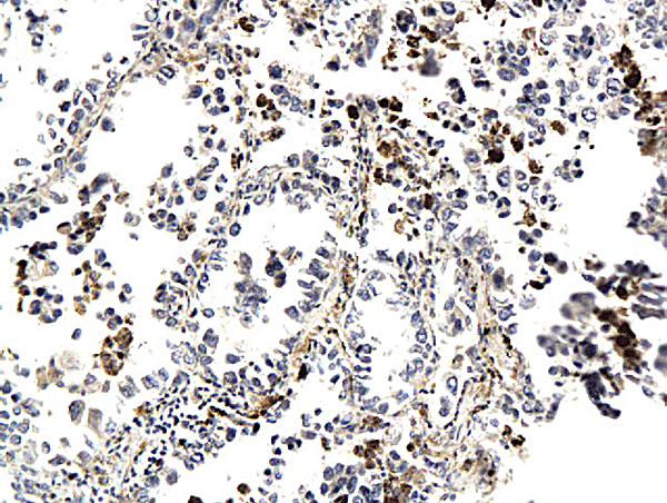 Formalin-fixed and paraffin embedded human lung cancer labeled with Anti-CK7 (Human) Polyclonal Antibody, Unconjugated (bs-1610R) followed by conjugation to the secondary antibody and DAB staining