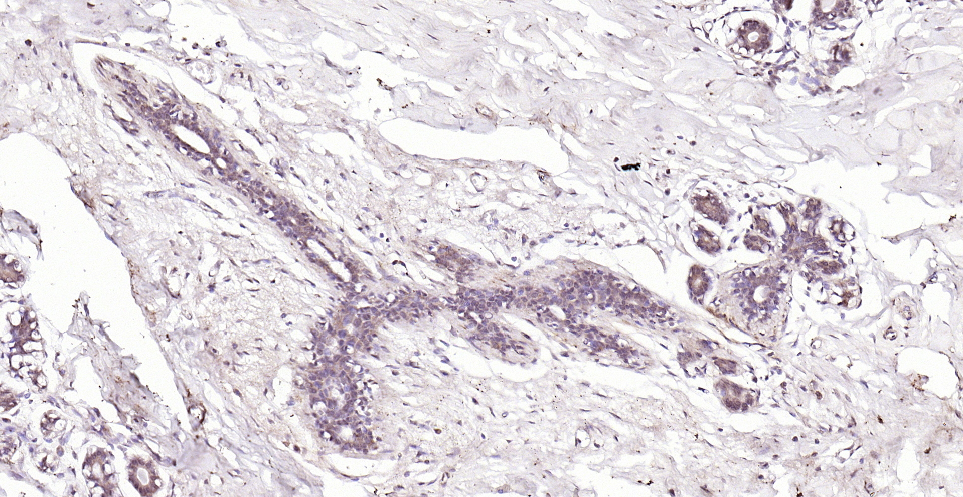Paraformaldehyde-fixed, paraffin embedded (human breast); Antigen retrieval by boiling in sodium citrate buffer (pH6.0) for 15min; Block endogenous peroxidase by 3% hydrogen peroxide for 20 minutes; Blocking buffer (normal goat serum) at 37°C for 30min; Antibody incubation with (Tenomodulin) Polyclonal Antibody, Unconjugated (bs-7525R) at 1:200 overnight at 4°C, followed by operating according to SP Kit(Rabbit) (sp-0023) instructionsand DAB staining. Paraformaldehyde-fixed, paraffin embedded (human breast); Antigen retrieval by boiling in sodium citrate buffer (pH6.0) for 15min; Block endogenous peroxidase by 3% hydrogen peroxide for 20 minutes; Blocking buffer (normal goat serum) at 37°C for 30min; Antibody incubation with (Tenomodulin) Polyclonal Antibody, Unconjugated (bs-7525R) at 1:200 overnight at 4°C, followed by operating according to SP Kit(Rabbit) (sp-0023) instructionsand DAB staining.