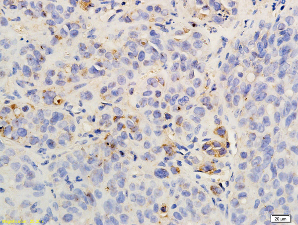 Formalin-fixed and paraffin embedded rat hepatoma labeled with Anti-CXCR2\/CD182 Polyclonal Antibody, Unconjugated (bs-1629R) followed by conjugation to the secondary antibody and DAB staining