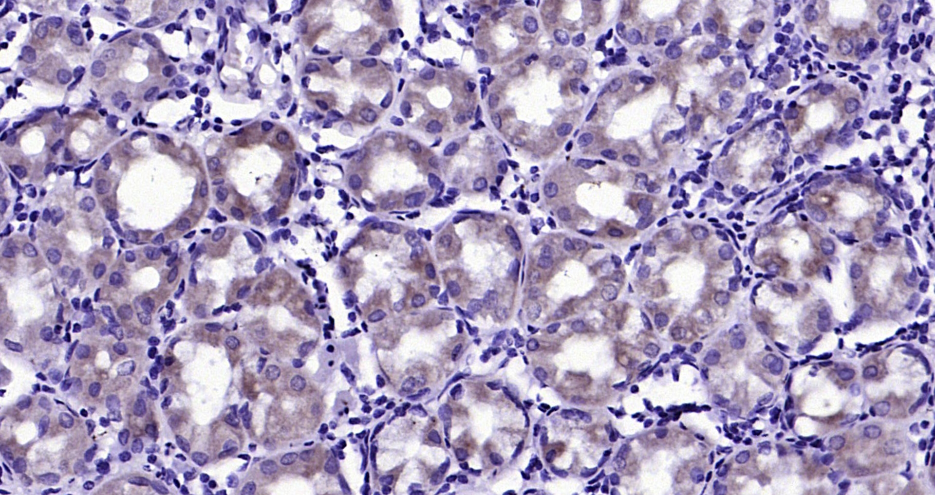 Paraformaldehyde-fixed, paraffin embedded (Human stomach); Antigen retrieval by boiling in sodium citrate buffer (pH6.0) for 15min; Block endogenous peroxidase by 3% hydrogen peroxide for 20 minutes; Blocking buffer (normal goat serum) at 37°C for 30min; Antibody incubation with (phospho-SHC1 (Ser36)) Polyclonal Antibody, Unconjugated (bs-3410R) at 1:200 overnight at 4°C, followed by operating according to SP Kit(Rabbit) (sp-0023) instructionsand DAB staining.
