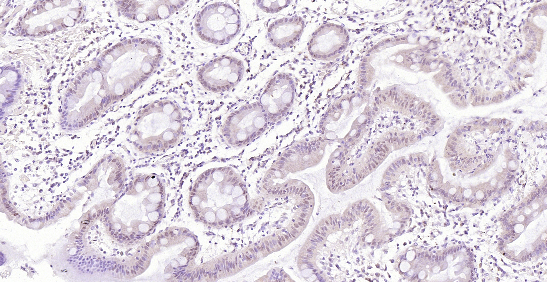 Paraformaldehyde-fixed, paraffin embedded (human gastric carcinoma); Antigen retrieval by boiling in sodium citrate buffer (pH6.0) for 15min; Block endogenous peroxidase by 3% hydrogen peroxide for 20 minutes; Blocking buffer (normal goat serum) at 37°C for 30min; Antibody incubation with (CDK6) Polyclonal Antibody, Unconjugated (bs-0568R) at 1:200 overnight at 4°C, followed by operating according to SP Kit(Rabbit) (sp-0023) instructionsand DAB staining.