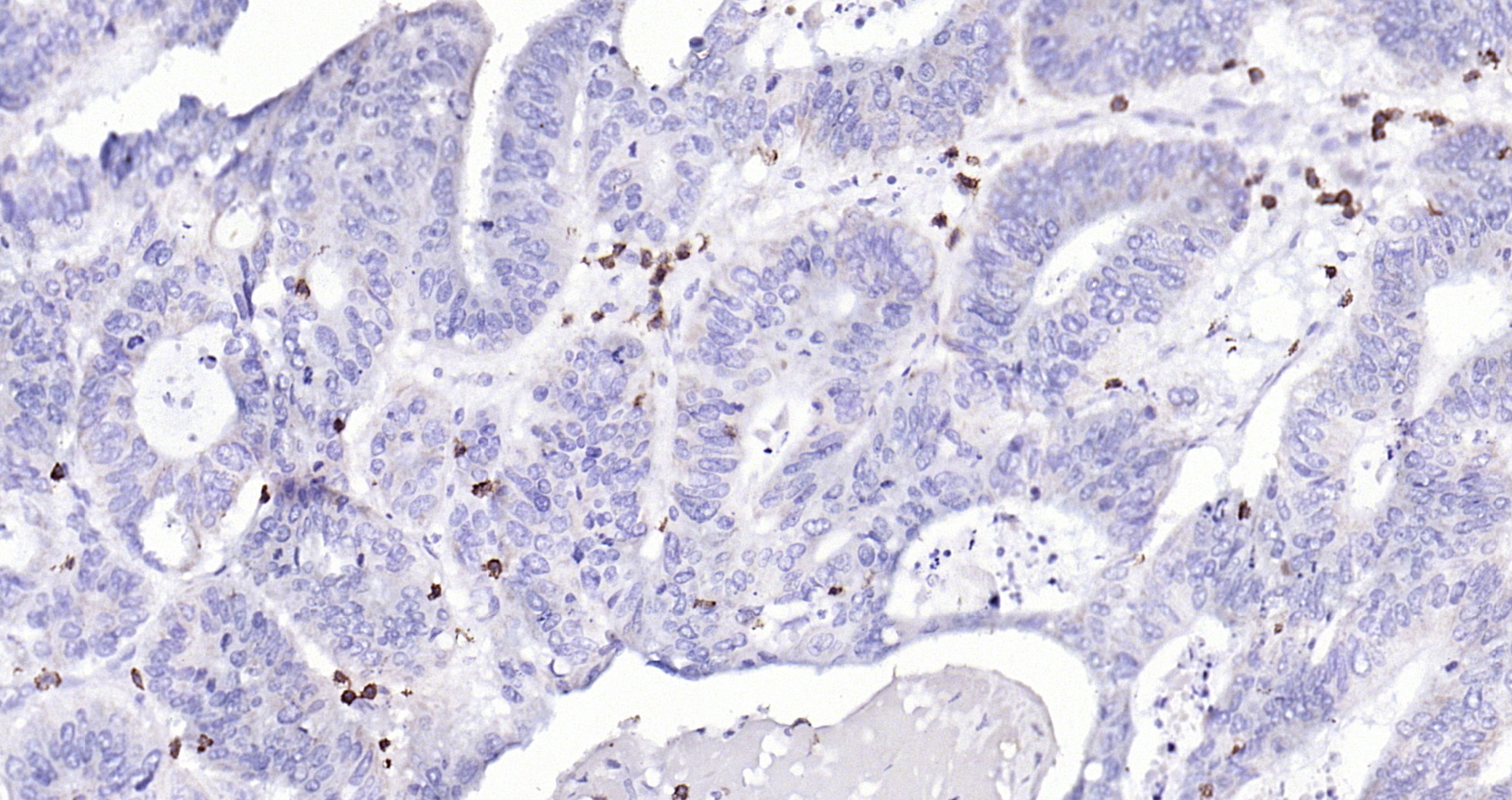 Paraformaldehyde-fixed, paraffin embedded (human colon carcinoma); Antigen retrieval by boiling in sodium citrate buffer (pH6.0) for 15min; Block endogenous peroxidase by 3% hydrogen peroxide for 20 minutes; Blocking buffer (normal goat serum) at 37°C for 30min; Antibody incubation with (CD3 epsilon (7A4)) Monoclonal Antibody, Unconjugated (bsm-52386R) at 1:200 overnight at 4°C, followed by operating according to SP Kit(Rabbit) (sp-0023) instructionsand DAB staining. Paraformaldehyde-fixed, paraffin embedded (human colon carcinoma); Antigen retrieval by boiling in sodium citrate buffer (pH6.0) for 15min; Block endogenous peroxidase by 3% hydrogen peroxide for 20 minutes; Blocking buffer (normal goat serum) at 37°C for 30min; Antibody incubation with (CD3 epsilon (7A4)) Monoclonal Antibody, Unconjugated (bsm-52386R) at 1:200 overnight at 4°C, followed by operating according to SP Kit(Rabbit) (sp-0023) instructionsand DAB staining.