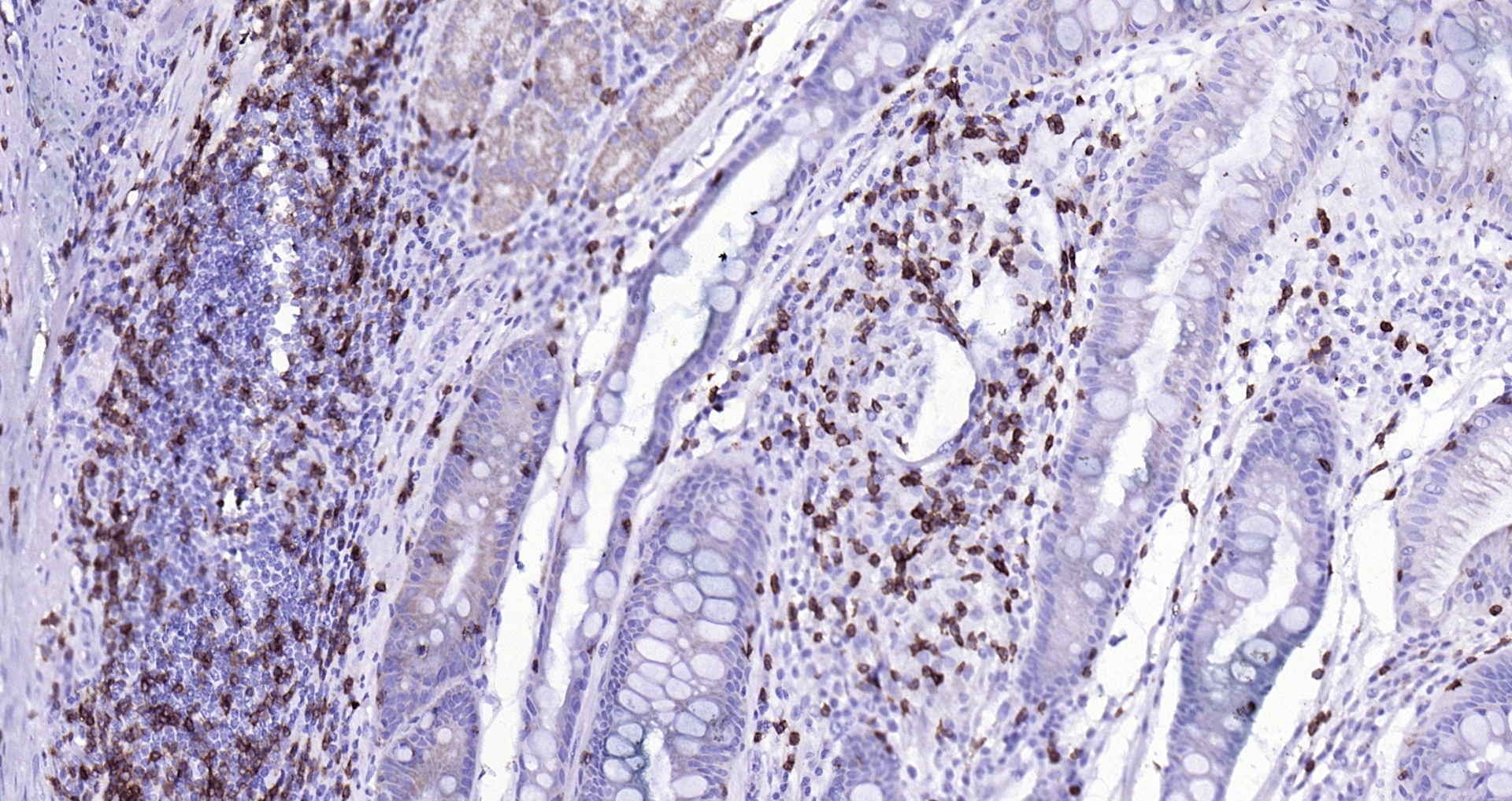 Paraformaldehyde-fixed, paraffin embedded (human gastric carcinoma); Antigen retrieval by boiling in sodium citrate buffer (pH6.0) for 15min; Block endogenous peroxidase by 3% hydrogen peroxide for 20 minutes; Blocking buffer (normal goat serum) at 37°C for 30min; Antibody incubation with (CD3 epsilon (7A4)) Monoclonal Antibody, Unconjugated (bsm-52386R) at 1:200 overnight at 4°C, followed by operating according to SP Kit(Rabbit) (sp-0023) instructionsand DAB staining. Paraformaldehyde-fixed, paraffin embedded (human gastric carcinoma); Antigen retrieval by boiling in sodium citrate buffer (pH6.0) for 15min; Block endogenous peroxidase by 3% hydrogen peroxide for 20 minutes; Blocking buffer (normal goat serum) at 37°C for 30min; Antibody incubation with (CD3 epsilon (7A4)) Monoclonal Antibody, Unconjugated (bsm-52386R) at 1:200 overnight at 4°C, followed by operating according to SP Kit(Rabbit) (sp-0023) instructionsand DAB staining.