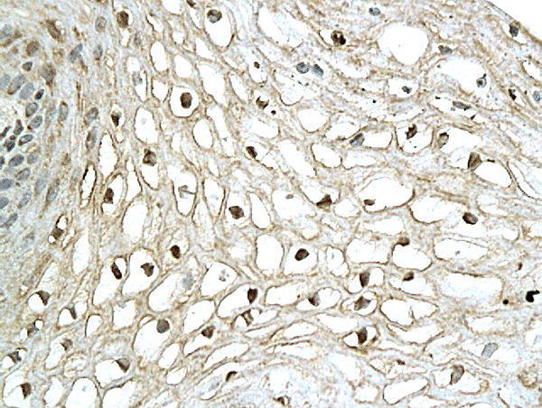 Formalin-fixed and paraffin embedded human cervical tissue labeled with Anti-XBP-1 Polyclonal Antibody, Unconjugated (bs-1668R) followed by conjugation to the secondary antibody and DAB staining