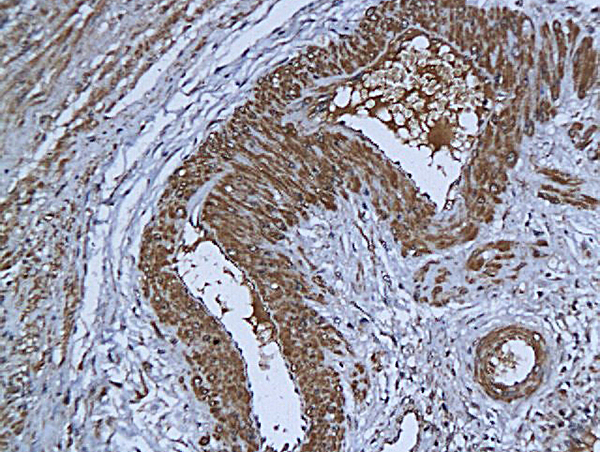 Formalin-fixed and paraffin-embedded human cervical cancer labeled with Anti-DAPK3 Polyclonal Antibody, Unconjugated (bs-1692R) at 1:200 followed by conjugation to the secondary antibody and DAB staining