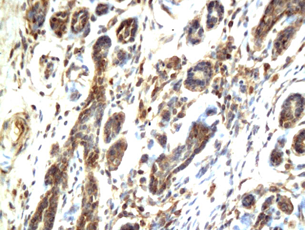 Formalin-fixed and paraffin embedded human breast cancer labeled with Anti-c-RafRaf1  Polyclonal Antibody, Unconjugated (bs-1703R) followed by conjugation to the secondary antibody and DAB staining