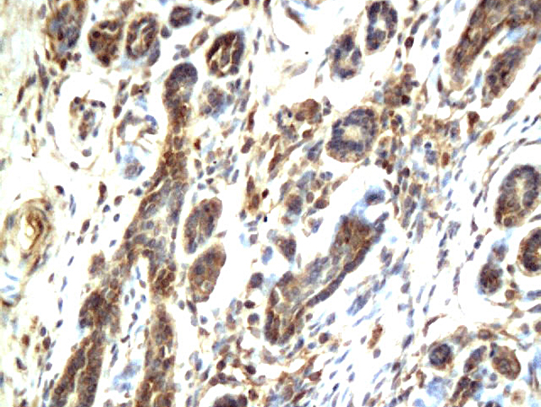 Formalin-fixed and paraffin embedded human breast cancer labeled with Anti-c-RafRaf1 Polyclonal Antibody, Unconjugated (bs-1703R) followed by conjugation to the secondary antibody and DAB staining