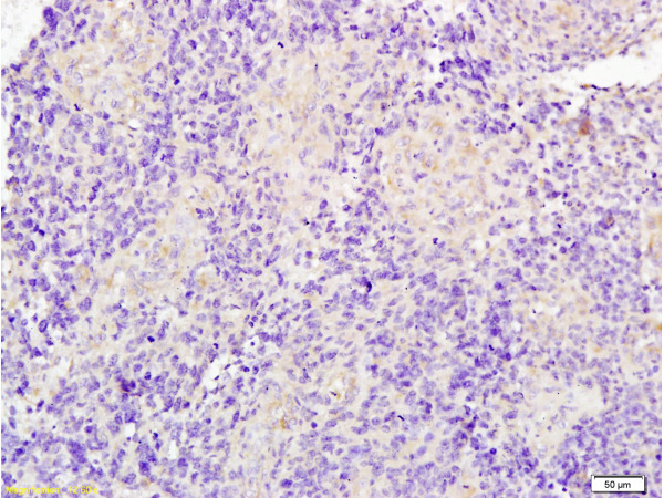Formalin-fixed and paraffin embedded human glioma tissue labeled with Anti-JUP/Cateninma γ Polyclonal Antibody, Unconjugated(bs-1720R) at 1:200 followed by conjugation to the secondary antibody and DAB staining
