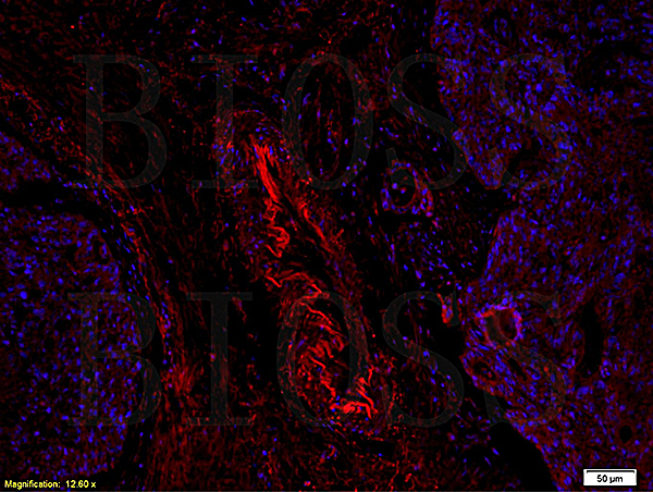 Formalin-fixed and paraffin embedded human rectal carcinoma labeled with Anti-ABCG4, Unconjugated(bs-1727R) followed by conjugation to the secondary antibody and DAPI staining\n