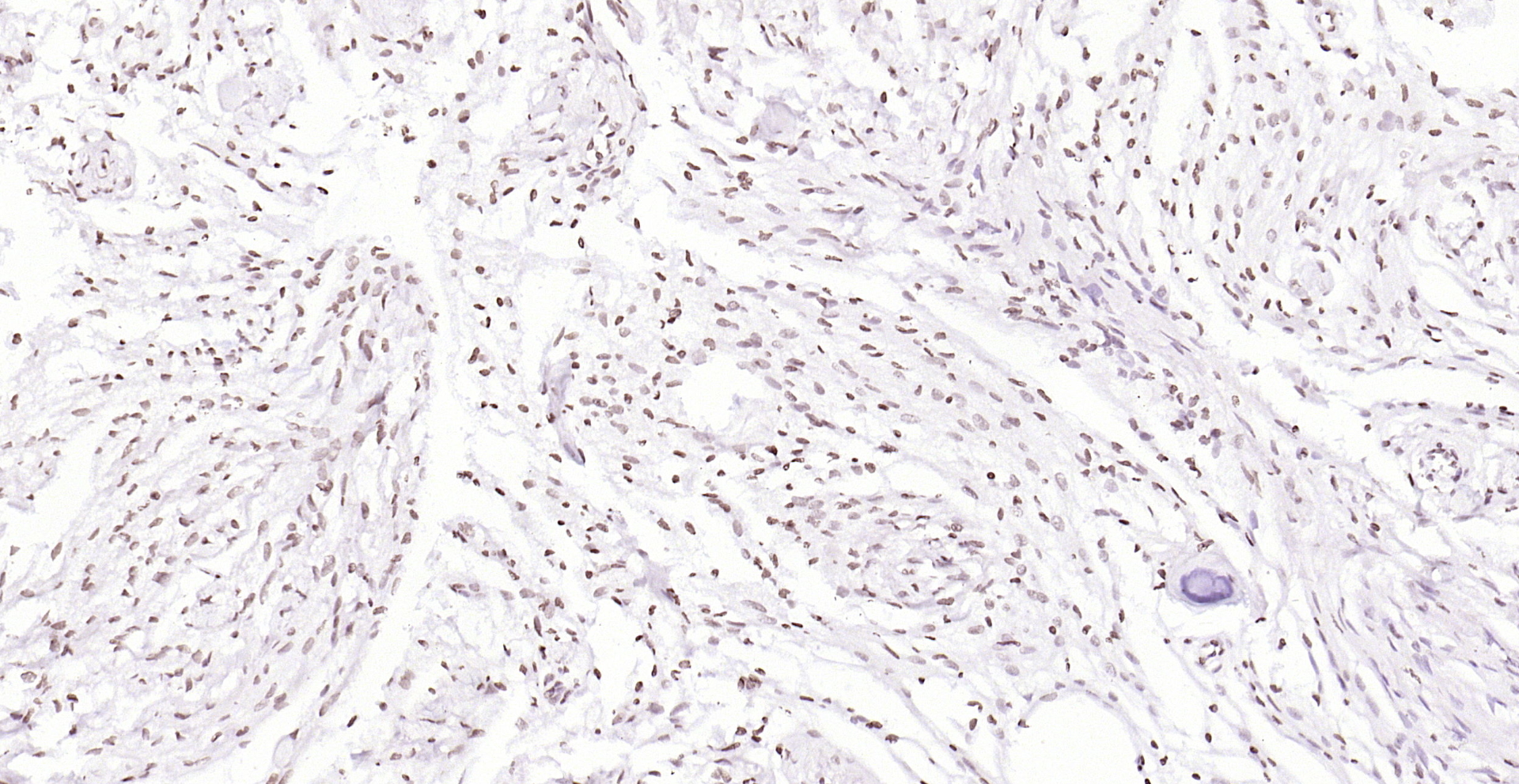 Paraformaldehyde-fixed, paraffin embedded (human brain glioma); Antigen retrieval by boiling in sodium citrate buffer (pH6.0) for 15min; Block endogenous peroxidase by 3% hydrogen peroxide for 20 minutes; Blocking buffer (normal goat serum) at 37°C for 30min; Antibody incubation with (PEG3) Polyclonal Antibody, Unconjugated (bs-1870R) at 1:200 overnight at 4°C, followed by operating according to SP Kit(Rabbit) (sp-0023) instructionsand DAB staining.