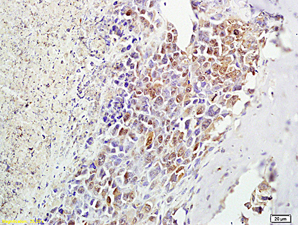 Formalin-fixed and paraffin embedded mouse foot tumor labeled with Anti-α-MSH, Unconjugated (bs-1848R) followed by conjugation to the secondary antibody