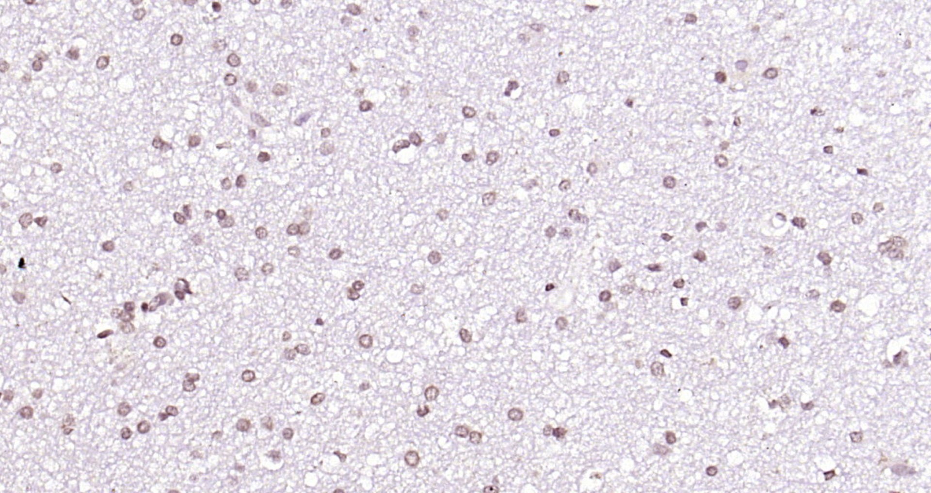 Paraformaldehyde-fixed, paraffin embedded (human brain glioma); Antigen retrieval by boiling in sodium citrate buffer (pH6.0) for 15min; Block endogenous peroxidase by 3% hydrogen peroxide for 20 minutes; Blocking buffer (normal goat serum) at 37°C for 30min; Antibody incubation with (HES5) Polyclonal Antibody, Unconjugated (bs-3767R) at 1:200 overnight at 4°C, followed by operating according to SP Kit(Rabbit) (sp-0023) instructionsand DAB staining.