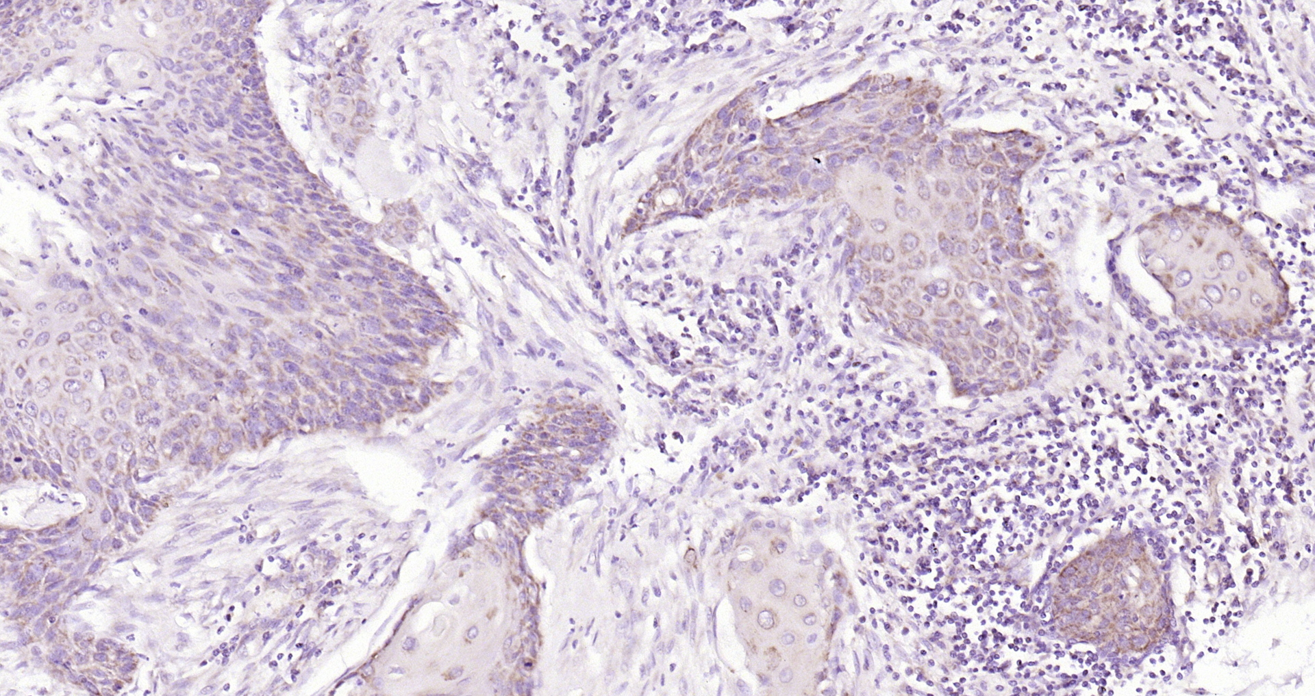 Paraformaldehyde-fixed, paraffin embedded (human cervical carcinoma); Antigen retrieval by boiling in sodium citrate buffer (pH6.0) for 15min; Block endogenous peroxidase by 3% hydrogen peroxide for 20 minutes; Blocking buffer (normal goat serum) at 37°C for 30min; Antibody incubation with (ERK4) Polyclonal Antibody, Unconjugated (bs-4131R) at 1:200 overnight at 4°C, followed by operating according to SP Kit(Rabbit) (sp-0023) instructionsand DAB staining.