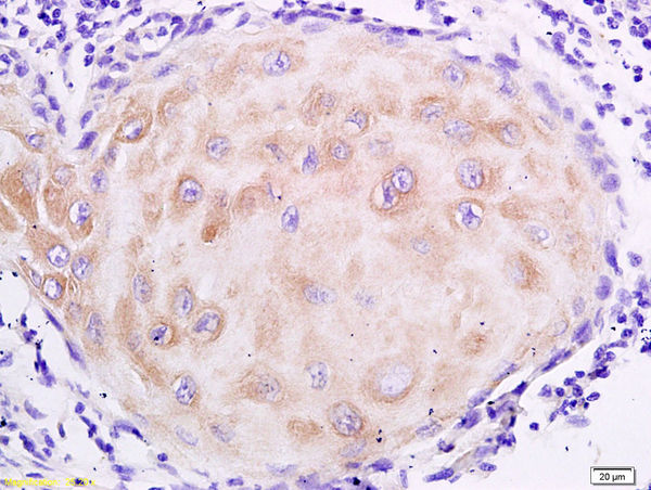 Formalin-fixed and paraffin embedded human oral squamous cell carcinoma labeled with Anti- MUC4 Polyclonal Antibody, Unconjugated (bs-1994R) at 1:200 followed by conjugation to the secondary antibody and DAB staining