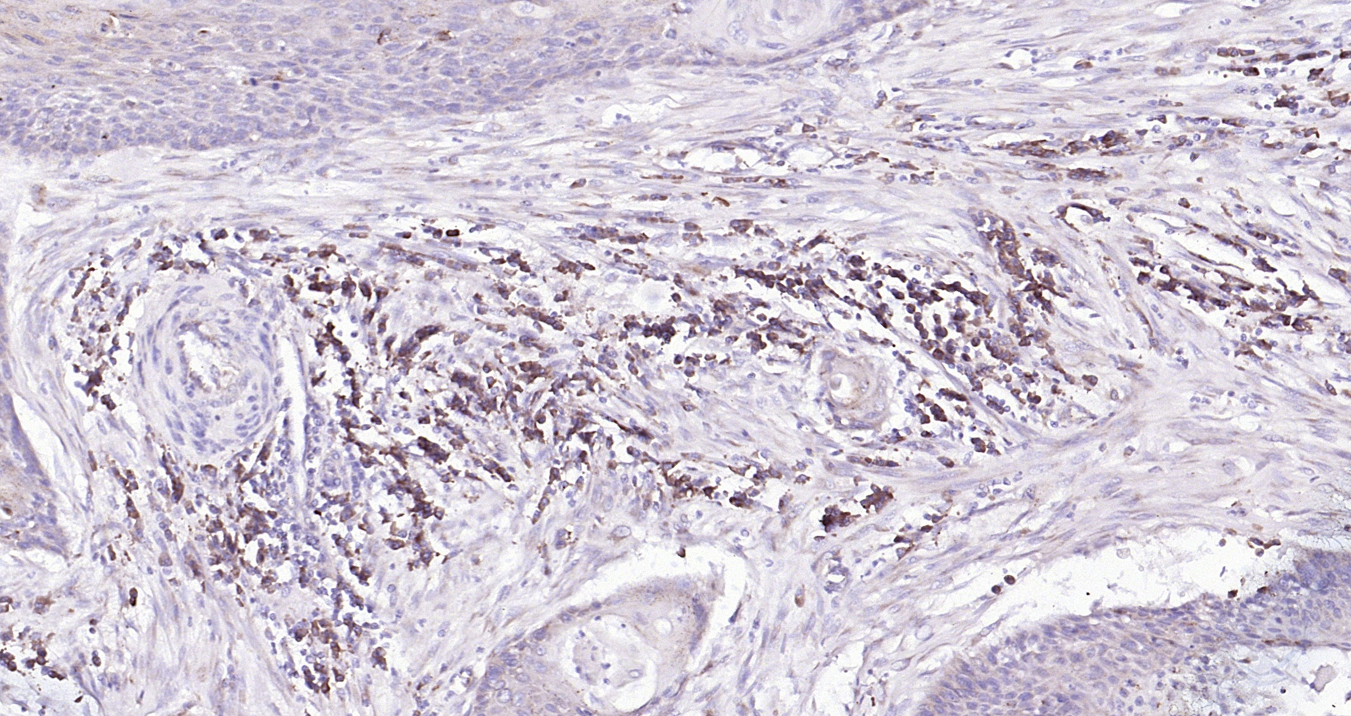 Paraformaldehyde-fixed, paraffin embedded (human cervical carcinoma); Antigen retrieval by boiling in sodium citrate buffer (pH6.0) for 15min; Block endogenous peroxidase by 3% hydrogen peroxide for 20 minutes; Blocking buffer (normal goat serum) at 37°C for 30min; Antibody incubation with (Mesothelin) Polyclonal Antibody, Unconjugated (bs-0300R) at 1:200 overnight at 4°C, followed by operating according to SP Kit(Rabbit) (sp-0023) instructionsand DAB staining.