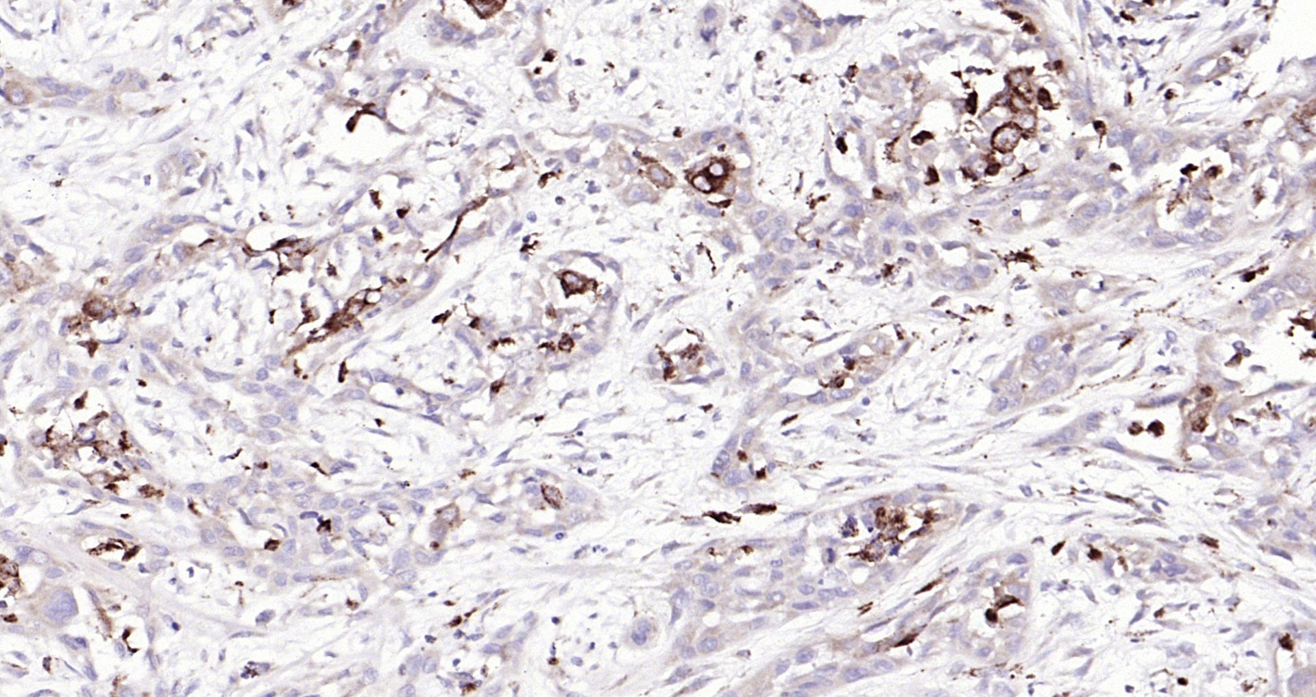 Paraformaldehyde-fixed, paraffin embedded (human gastric carcinoma); Antigen retrieval by boiling in sodium citrate buffer (pH6.0) for 15min; Block endogenous peroxidase by 3% hydrogen peroxide for 20 minutes; Blocking buffer (normal goat serum) at 37°C for 30min; Antibody incubation with (Mesothelin) Polyclonal Antibody, Unconjugated (bs-0300R) at 1:200 overnight at 4°C, followed by operating according to SP Kit(Rabbit) (sp-0023) instructionsand DAB staining.